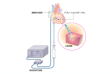 アブレーション 費用 カテーテル カテーテルアブレーションを体験！費用や痛み入院中で感じたこと